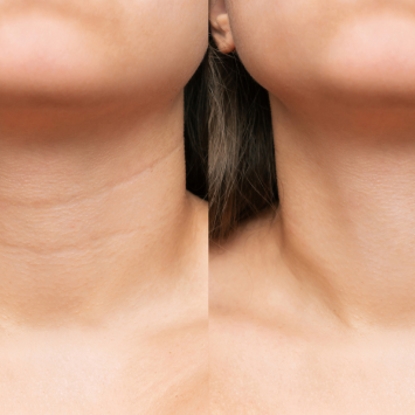 Neck Lift